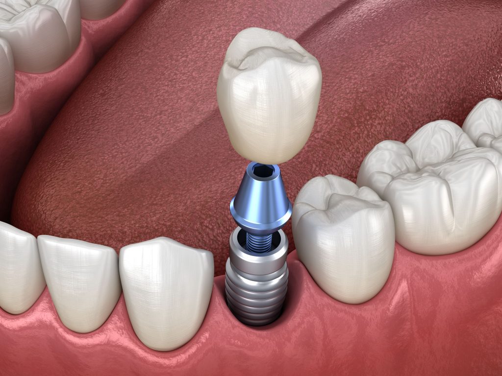 Dental Implants Orlando