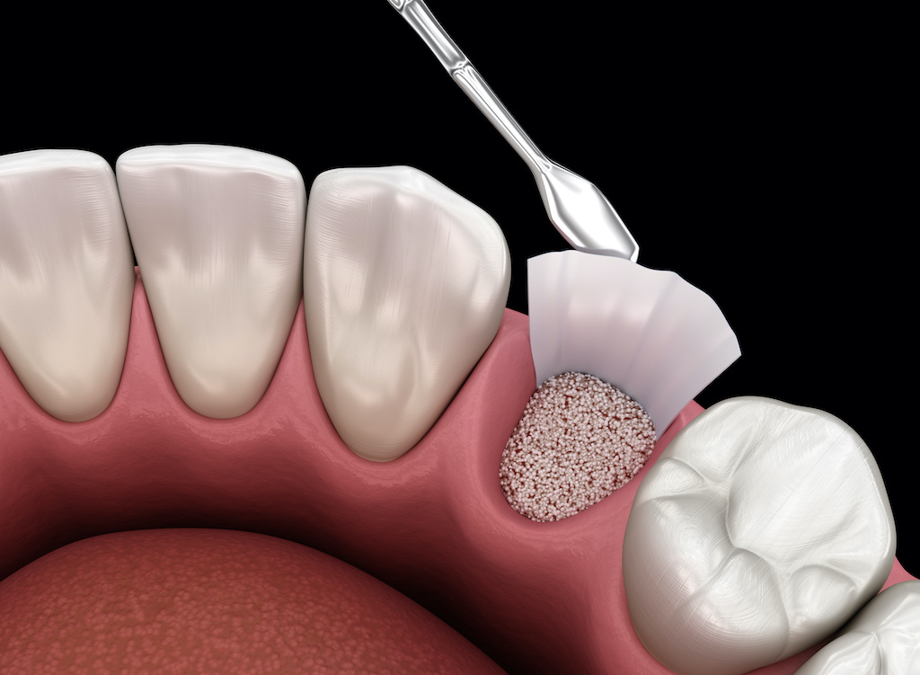 Bone Grafting Orlando